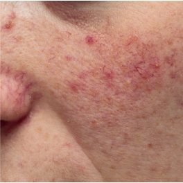 Rosaceás a bőröm
